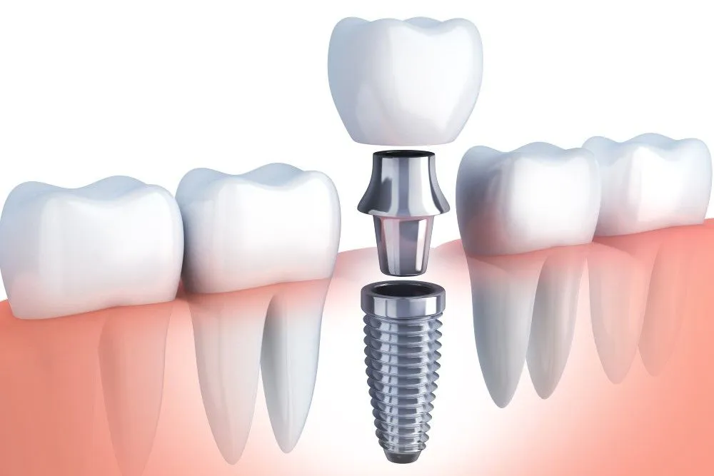 Dental implant components and teeth graphic.