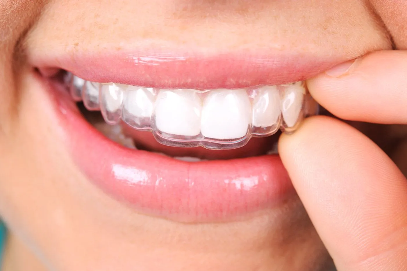 Clear dental aligners on teeth, close-up view.