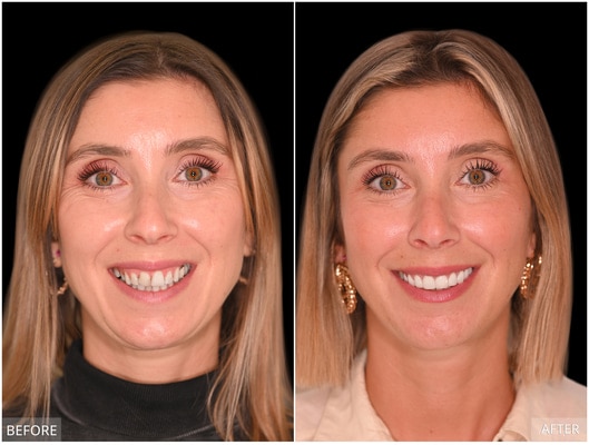 Woman's before and after cosmetic procedure.