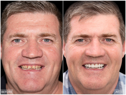 Man's dental transformation before and after teeth whitening.