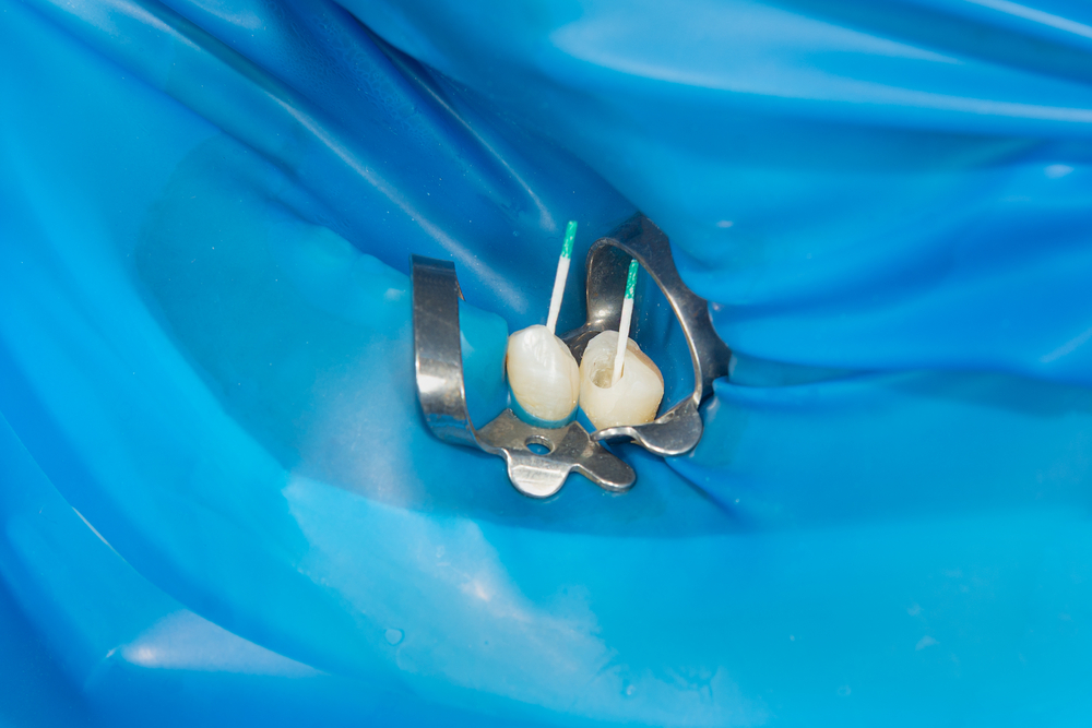 Dental extraction forceps removing teeth on blue background.